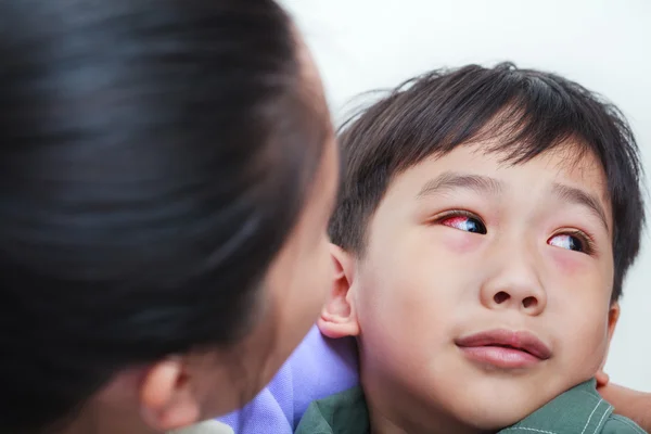 Close-up van chronische conjunctivitis met een rode iris. — Stockfoto