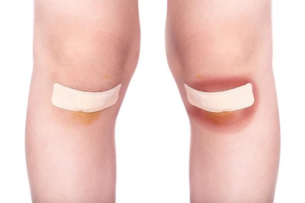 Child knees with a plaster (for wounds) and bruise — Stock Photo, Image