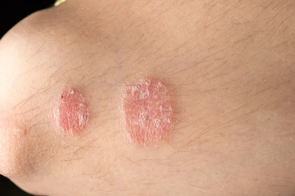 Enfermedad de la piel psoriasis —  Fotos de Stock