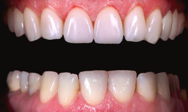 Beyazlatma işleminden önce ve sonra mükemmel bir gülümseme zirkon kemer seramik protezinin beyazlatılması implantlar taçlandırılır. Diş tedavisi kliniği hastası. Ağız cerrahisi dişçiliği sonucu,