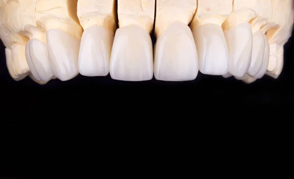 Zirkon kemer seramiklerinden yapılmış dolgun dişler diş protezinin üst kaplamalarının insan dişlerini taçlandırıyor. Diş tedavisi kliniği hastası. Siyah arka plandaki implantlar yakın plan cerrahi diş hekimi.