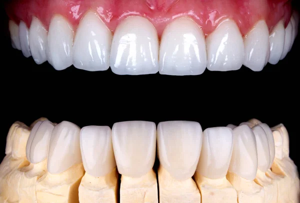Beyazlatma işleminden önce ve sonra mükemmel bir gülümseme zirkon kemer seramik protezinin beyazlatılması implantlar taçlandırılır. Diş tedavisi kliniği hastası. Ağız cerrahisi dişçiliği sonucu,