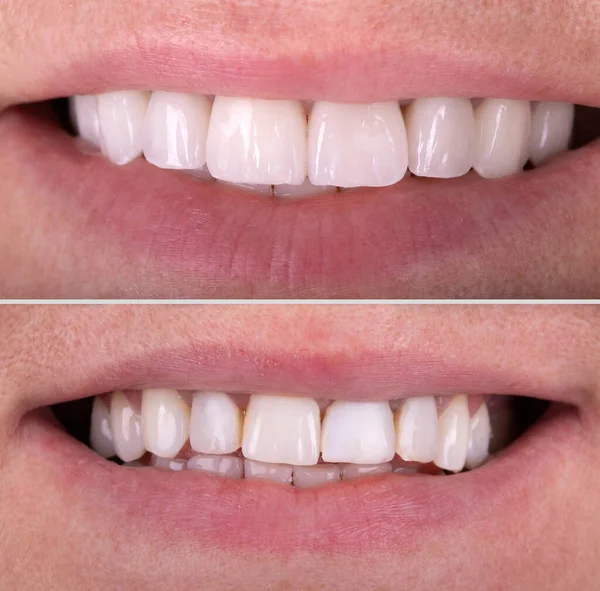 Senyum Sempurna Sebelum Dan Setelah Pemutihan Prosedur Pemutihan Zirkon Lengkungan — Stok Foto
