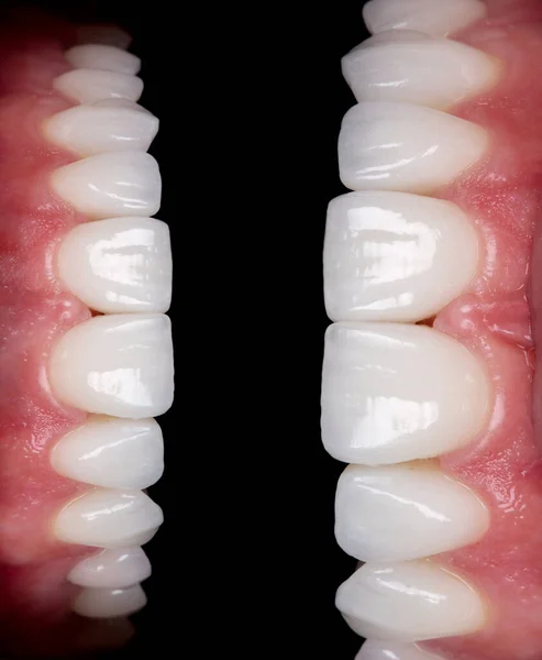 Diş taşı model zirkon kemer protez implantlarında seramik seramik kaplamalar ve kaplamalar. Diş tedavisi kliniği hastası. ağız cerrahisi