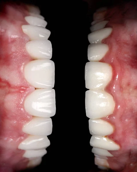 氧化锆拱形陶瓷假体植入冠漂白前后的完美笑容 牙科康复治疗诊所的病人 口腔外科及牙科结果 — 图库照片