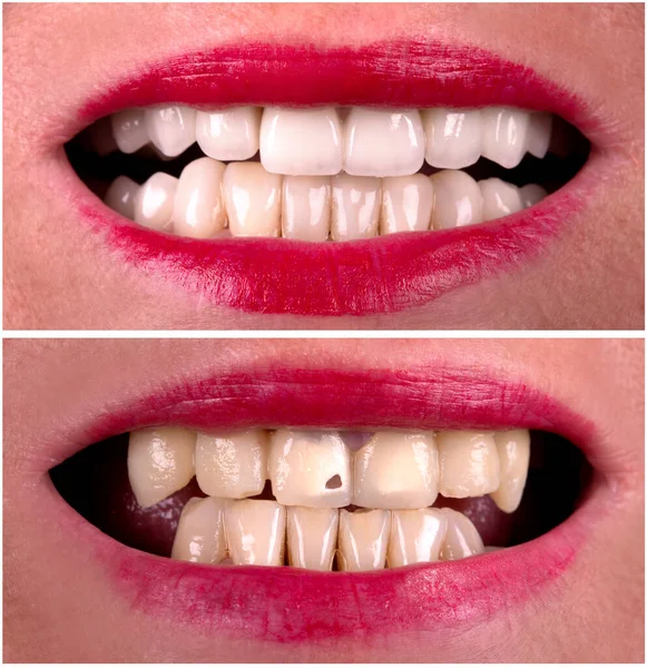 Sorriso Perfeito Antes Depois Branqueamento Procedimento Zircão Arco Prótese Cerâmica — Fotografia de Stock