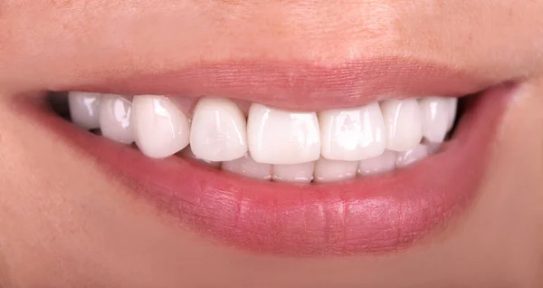 Denti Sani Perfetti Bel Sorriso Ampio Sbiancamento Corone Ceramica Sbiancamento — Foto Stock