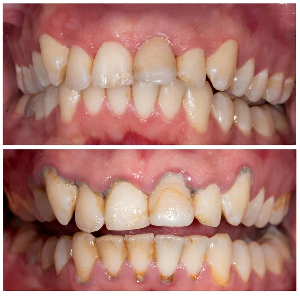 氧化锆拱形陶瓷假体植入冠漂白前后的完美笑容 牙科康复治疗诊所的病人 口腔外科及牙科结果 — 图库照片