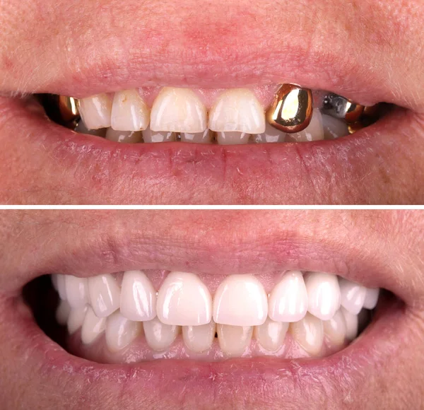 Beyazlatma işleminden önce ve sonra mükemmel bir gülümseme zirkon kemer seramik protezinin beyazlatılması implantlar taçlandırılır. Diş tedavisi kliniği hastası. Ağız cerrahisi dişçiliği sonucu,