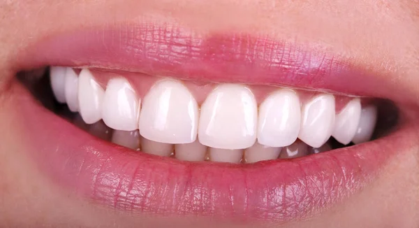 Perfect Healthy Teeth Beautiful Wide Smile Bleaching Ceramic Crowns Whitening — Stock Photo, Image
