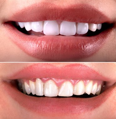 Beyazlatma işleminden önce ve sonra mükemmel bir gülümseme zirkon kemer seramik protezinin beyazlatılması implantlar taçlandırılır. Diş tedavisi kliniği hastası. Ağız cerrahisi dişçiliği sonucu,