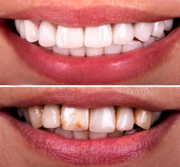 Senyum Sempurna Sebelum Dan Setelah Pemutihan Prosedur Pemutihan Zirkon Lengkungan — Stok Foto