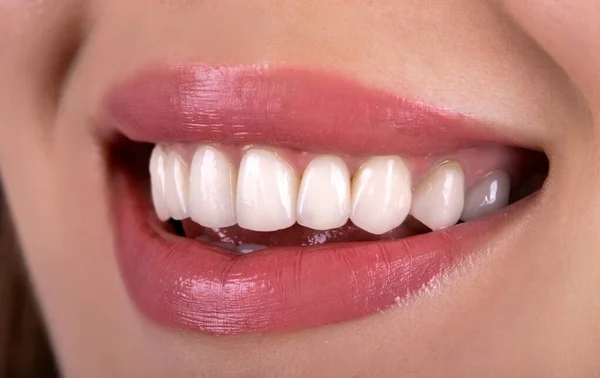 Perfect Healthy Teeth Beautiful Wide Smile Bleaching Ceramic Crowns Whitening — Stock Photo, Image