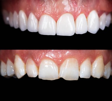 Beyazlatma işleminden önce ve sonra mükemmel bir gülümseme zirkon kemer seramik protezinin beyazlatılması implantlar taçlandırılır. Diş tedavisi kliniği hastası. Ağız cerrahisi dişçiliği sonucu,