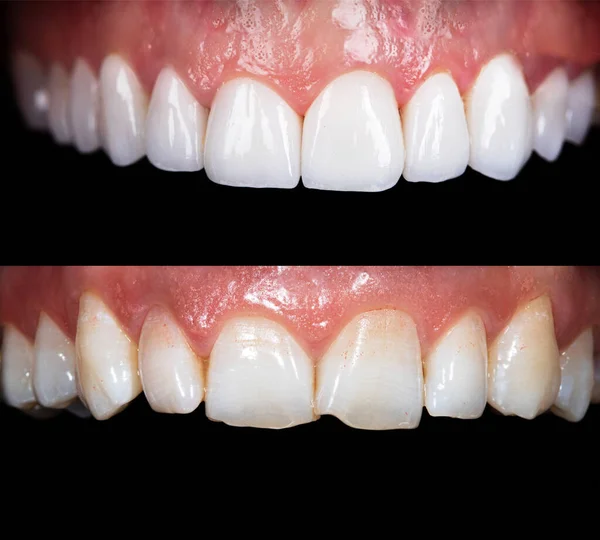 Beyazlatma işleminden önce ve sonra mükemmel bir gülümseme zirkon kemer seramik protezinin beyazlatılması implantlar taçlandırılır. Diş tedavisi kliniği hastası. Ağız cerrahisi dişçiliği sonucu,