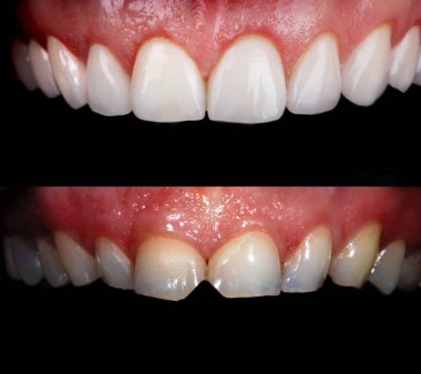 Beyazlatma işleminden önce ve sonra mükemmel bir gülümseme zirkon kemer seramik protezinin beyazlatılması implantlar taçlandırılır. Diş tedavisi kliniği hastası. Ağız cerrahisi dişçiliği sonucu,