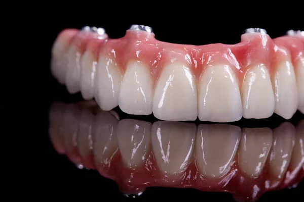 Belos Dentes Superiores Cerâmica Imprensa Coroas Cerâmica Folheados Sobre Modelo — Fotografia de Stock