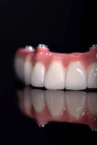 Diş taşı model zirkon kemer protez implantlarında seramik seramik kaplamalar ve kaplamalar. Diş tedavisi kliniği hastası. ağız cerrahisi