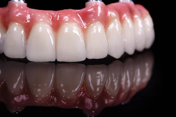 Diş taşı model zirkon kemer protez implantlarında seramik seramik kaplamalar ve kaplamalar. Diş tedavisi kliniği hastası. ağız cerrahisi