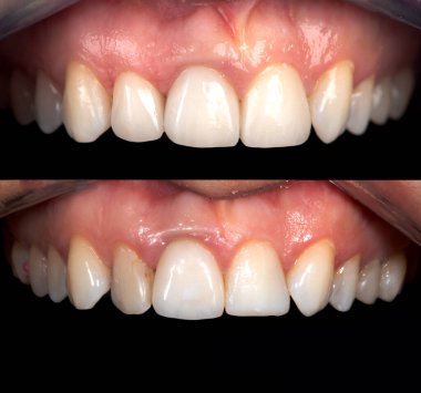 Beyazlatma işleminden önce ve sonra mükemmel bir gülümseme zirkon kemer seramik protezinin beyazlatılması implantlar taçlandırılır. Diş tedavisi kliniği hastası. Ağız cerrahisi dişçiliği sonucu,