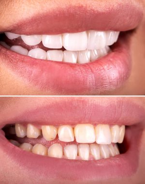 Beyazlatma işleminden önce ve sonra mükemmel bir gülümseme zirkon kemer seramik protezinin beyazlatılması implantlar taçlandırılır. Diş tedavisi kliniği hastası. Ağız cerrahisi dişçiliği sonucu,