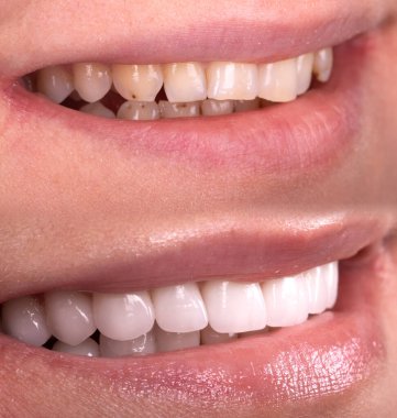 Beyazlatma işleminden önce ve sonra mükemmel bir gülümseme zirkon kemer seramik protezinin beyazlatılması implantlar taçlandırılır. Diş tedavisi kliniği hastası. Ağız cerrahisi dişçiliği sonucu,