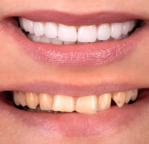 Beyazlatma işleminden önce ve sonra mükemmel bir gülümseme zirkon kemer seramik protezinin beyazlatılması implantlar taçlandırılır. Diş tedavisi kliniği hastası. Ağız cerrahisi dişçiliği sonucu,