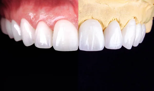 Perfect smile before and after veneers bleach of zircon arch ceramic prothesis Implants crowns. Dental restoration treatment clinic patient. Result of oral surgery procedure whitening dentistry