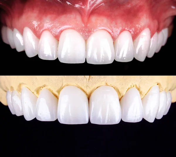 Perfect smile before and after veneers bleach of zircon arch ceramic prothesis Implants crowns. Dental restoration treatment clinic patient. Result of oral surgery procedure whitening dentistry
