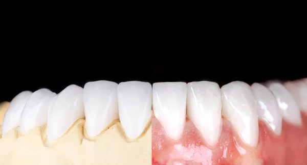 Perfect smile before and after veneers bleach of zircon arch ceramic prothesis Implants crowns. Dental restoration treatment clinic patient. Result of oral surgery procedure whitening dentistry