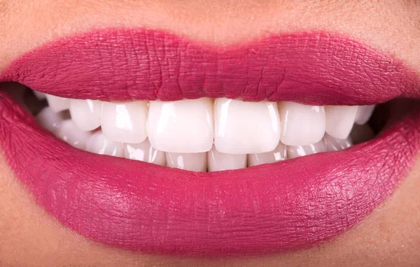 Perfect Close Up White beautiful Veneers Teeth bleaching crowns whitening young lady smiling, Sensual sexy Seductive plump Lips woman smile . Dental zircon implants restoration surgery. Fashion concept