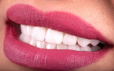 Kusursuz Kapalı Beyaz Venedikliler dişleri beyazlatan genç bayan gülümseyen şehvetli, baştan çıkarıcı, tombul dudaklı kadın gülüşü. Diş zirkon implantı yenileme ameliyatı. Moda konsepti