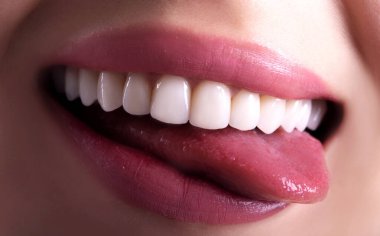 Kusursuz Kapalı Beyaz Venedikliler dişleri beyazlatan genç bayan gülümseyen şehvetli, baştan çıkarıcı, tombul dudaklı kadın gülüşü. Diş zirkon implantı yenileme ameliyatı. Moda konsepti