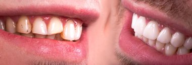 Zirkon kemeri seramik protezinin kaplamaları beyazlatılmadan önce ve sonra mükemmel bir gülümseme. Diş tedavisiyle uğraşan hasta. Geniş Ağız Cerrahisi Prosedürü Sancakları Diş beyazlatma