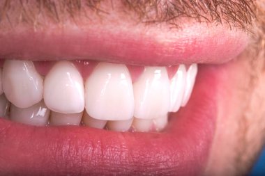 Kusursuz Yakın Beyaz Venedik 'li güzel dişleri beyazlatan genç bayan gülümseyen, erkek sakallı doğal erkek gülüşü. Diş zirkon implantı yenileme ameliyatı. Moda konsepti