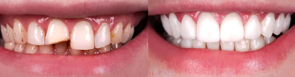 氧化锆拱形陶瓷假体植入冠冕前 后的完美笑容 牙齿修复治疗病人 大旗口腔手术程序美白牙 — 图库照片