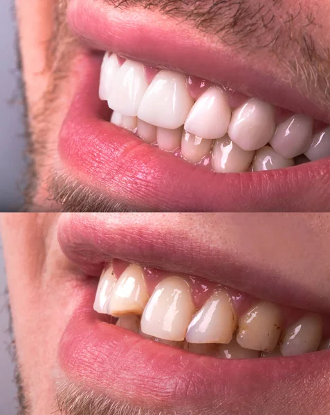 Sorriso Perfeito Antes Depois Folheados Alvejante Zircão Arco Prótese Cerâmica — Fotografia de Stock