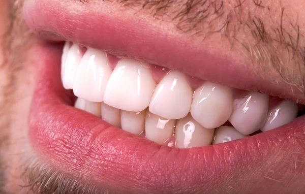 Perfect Close White Beautiful Veneers Teeth Bleaching Crowns Whitening Young — Stock Photo, Image