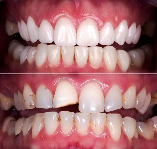氧化锆拱形陶瓷假体植入冠冕前 后的完美笑容 牙科康复治疗诊所的病人 口腔外科手术美白牙的结果 — 图库照片