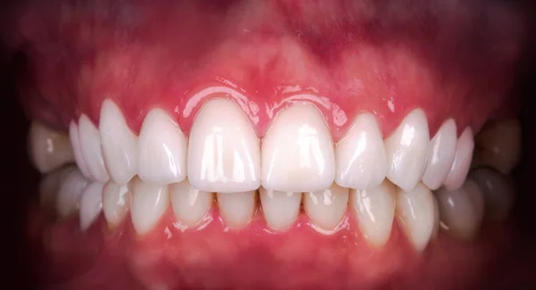 Zirkon kemeri seramik protez kaplamasından sonraki mükemmel gülümseme implantları taçlandırır. Diş tedavisi kliniği hastası. Ağız cerrahisi prosedürünün sonucu diş beyazlatma