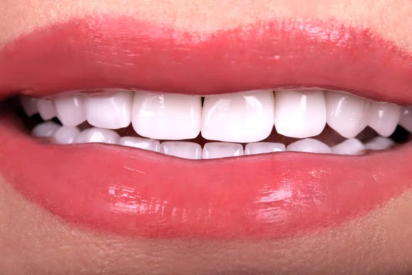 Perfekte Nahaufnahme Weiße Schöne Veneers Zahnbleichkronen Bleaching Junge Dame Lächelnd — Stockfoto