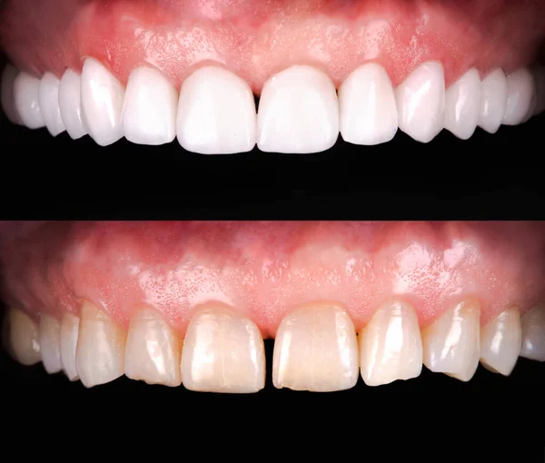 Sorriso Perfeito Antes Depois Folheados Alvejante Zircão Arco Prótese Cerâmica — Fotografia de Stock