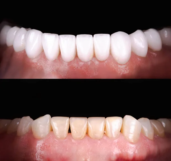 Sorriso Perfetto Prima Dopo Impiallacciature Candeggina Zircone Arco Protesi Ceramica — Foto Stock