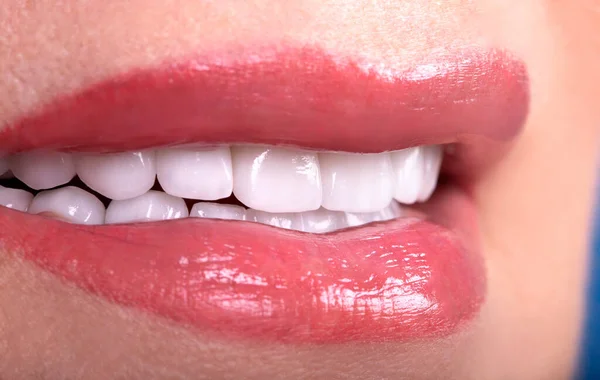 Perfetto Close Bianco Belle Impiallacciature Denti Corone Sbiancanti Giovane Signora — Foto Stock