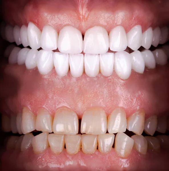 Sorriso Perfeito Antes Depois Folheados Alvejante Zircão Arco Prótese Cerâmica — Fotografia de Stock