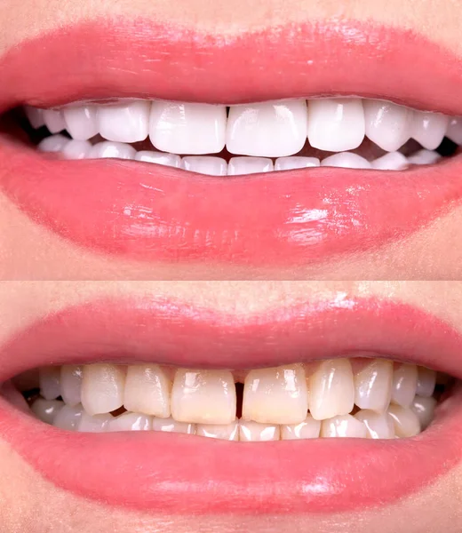 Perfect smile before and after veneers bleach of zircon arch ceramic prothesis Implants crowns. Dental restoration treatment clinic patient. Result of oral surgery procedure whitening dentistry