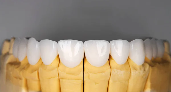 Güzel üst dişli seramik kaplamalar zirkon kemer protezinin beyazlatıcısı implantlar taçlandırılıyor. Diş tedavisi kliniği hastası. Ağız cerrahisi prosedürünün sonucu diş beyazlatma