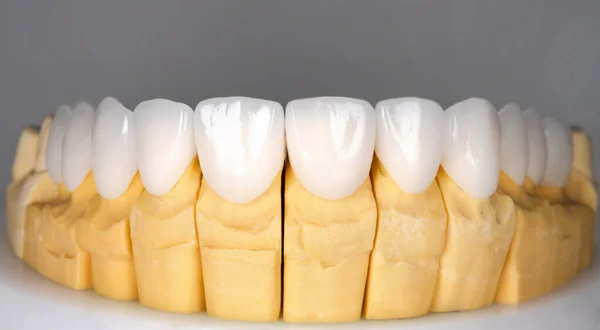 Bellissimi Denti Superiori Ceramica Impiallacciature Stampa Candeggina Zircone Arco Protesi — Foto Stock