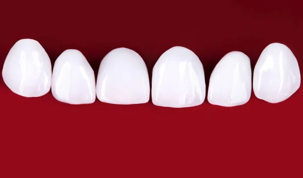 Dentaduras Cerâmicas Coroas Sobre Fundo Preto Vista Superior Conjunto Dentaduras — Fotografia de Stock
