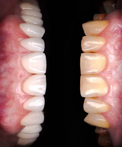 氧化锆拱形陶瓷假体植入冠冕前 后的完美笑容 牙科康复治疗诊所的病人 老年妇女牙齿美白手术程序 — 图库照片